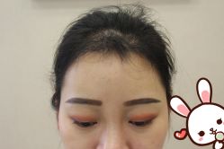 点击看大图 -大麦微针植发丨全国连锁