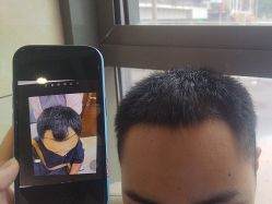 点击看大图 -碧莲盛·不剃发植发