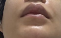 体验后-深圳米兰柏羽医疗美容医院