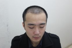 点击看大图 -大麦微针植发丨全国连锁