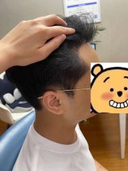 -大麦微针植发全国连锁