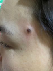 -北京美痣堂古方祛痣斑疣瘊