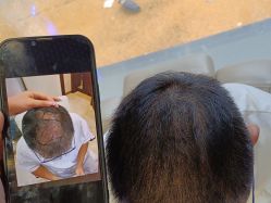 -碧莲盛·不剃发植发