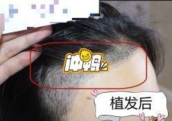 -大麦微针植发全国连锁