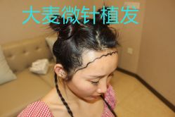 -大麦微针植发丨全国连锁