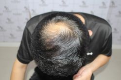 -大麦微针植发丨全国连锁