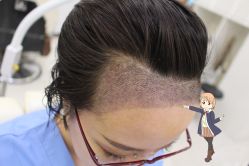 -大麦微针植发丨全国连锁