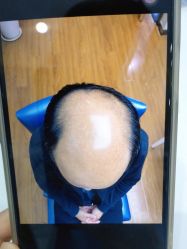 -大麦微针植发全国连锁