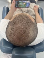 点击看大图 -大麦微针植发全国连锁