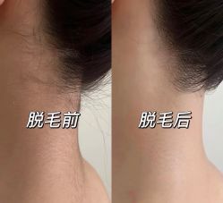 -薇兰专业脱毛连锁机构