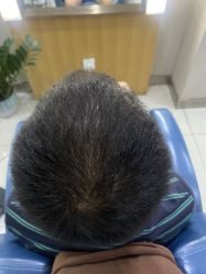 -大麦微针植发全国连锁