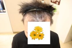 -大麦微针植发丨全国连锁