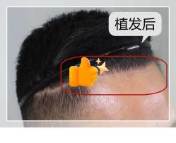 -大麦微针植发全国连锁