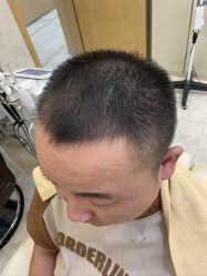 -大麦微针植发丨全国连锁