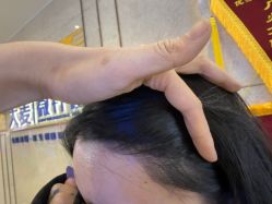 -大麦微针植发全国连锁