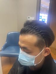 体验后-大麦微针植发全国连锁