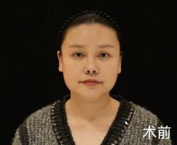 体验前-杭州米兰柏羽医疗美容医院