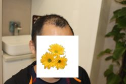 -大麦微针植发丨全国连锁