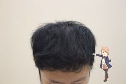 -大麦微针植发丨全国连锁