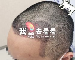 -大麦微针植发全国连锁