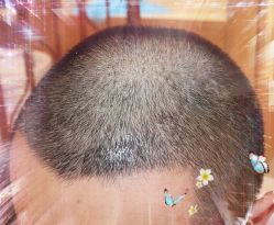 -大麦微针植发全国连锁