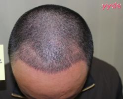 -大麦微针植发丨全国连锁