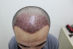 点击看大图 -大麦微针植发丨全国连锁