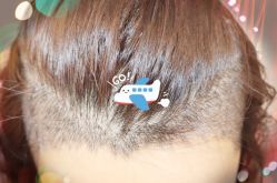 -大麦微针植发全国连锁