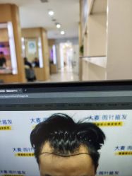 -大麦微针植发丨全国连锁