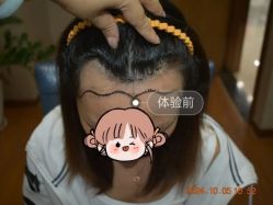 -大麦微针植发全国连锁