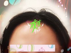 -大麦微针植发全国连锁