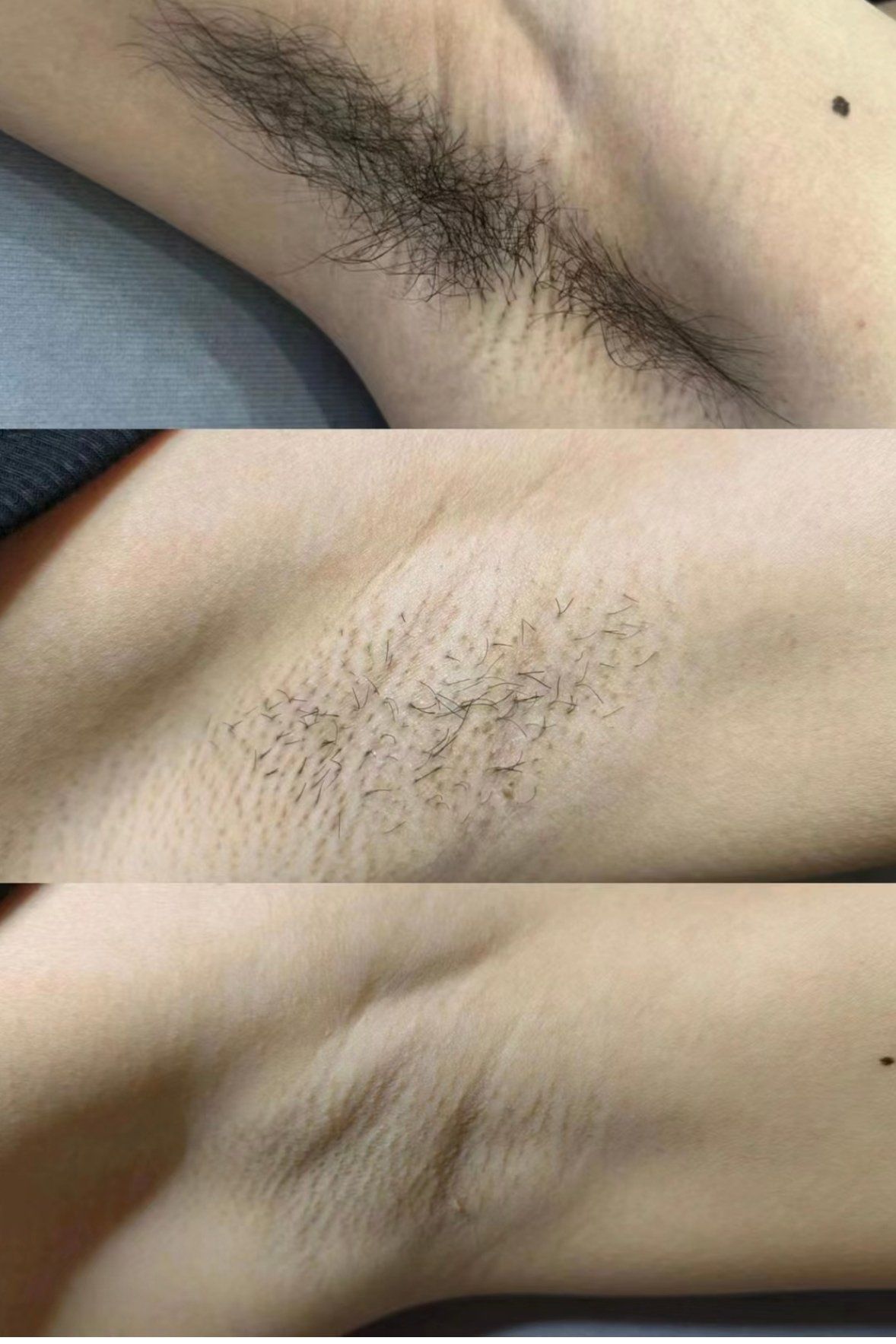 男士腋下脱毛对比