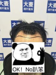 -大麦微针植发丨全国连锁