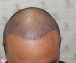 -大麦微针植发丨全国连锁