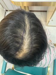 -碧莲盛不剃发植发