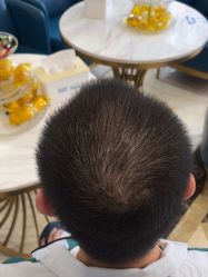 -碧莲盛·不剃发植发