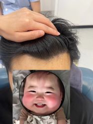 -大麦微针植发全国连锁