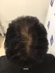 点击看大图 -大麦微针植发丨全国连锁