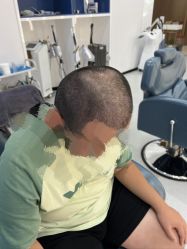 体验后-大麦微针植发全国连锁