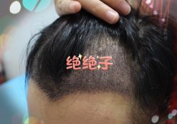 -大麦微针植发全国连锁