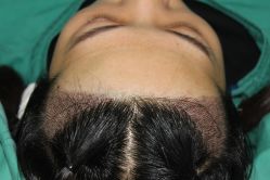 体验后-大麦微针植发全国连锁