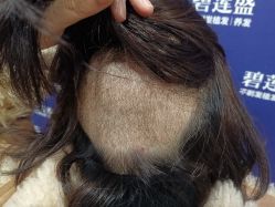 -碧莲盛·不剃发植发