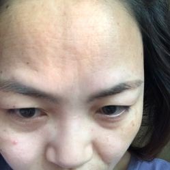 体验后-More摩尔医美の注射线雕光电中心
