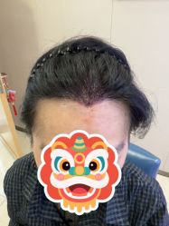 -大麦微针植发全国连锁