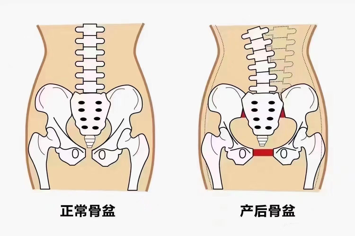 徒手骨盆闭合健康又美丽