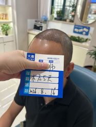 -大麦微针植发丨全国连锁