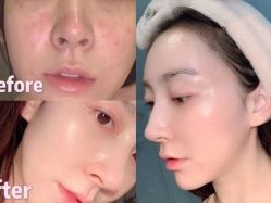 点击看大图 -美肤盾祛痘·问题肌头疗管理中心