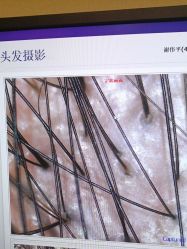 -大麦微针植发全国连锁