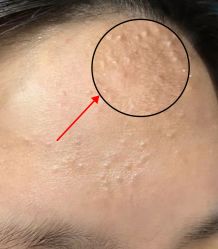 -成都苗方清颜专业祛痘