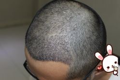 -大麦微针植发丨全国连锁